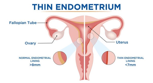fertility-issue-thin-endometrium